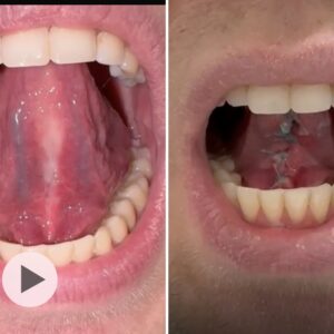 Vor-/Nachsorge bei sublingualer Faszienplastik, Erwachsene und ältere Kinder