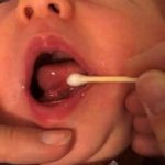 Rautenförmige Wunde unter der Zunge durch Schnitt des hinteren Zungenbändchens